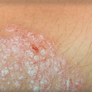 انواع بیماری‌های پوستی (skin diseases)